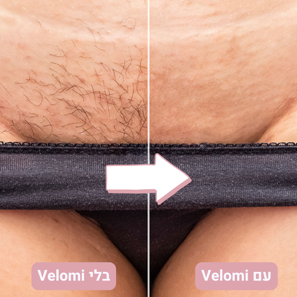 ™Velomy- המכונה הנמכרת ביותר בישראל להסרת שיער באזורים האינטימיים