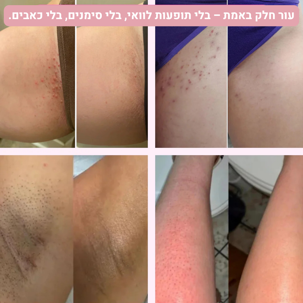 ™Velomy- המכונה הנמכרת ביותר בישראל להסרת שיער באזורים האינטימיים